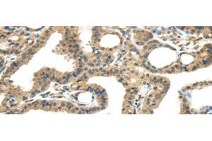 Immunohistochemistry of paraffin-embedded Human thyroid cancer tissue using TMPRSS11E Polyclonal Antibody at dilution 1:45 (TMPRSS11E Antikörper)