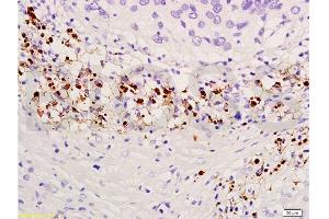 Formalin-fixed and paraffin embedded human endometrium carcinoma labeled with Anti-TIMP-4 Polyclonal Antibody, Unconjugated  at 1:300, followed by conjugation to the secondary antibody and DAB staining
