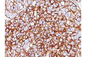 Formalin-fixed, paraffin-embedded human breast carcinoma stained with CD44 antibody (HCAM/918)