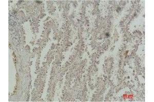 Immunohistochemical analysis of paraffin-embedded Human Lung Carcinoma using CREB-1 Monoclonal Antibody. (CREB1 Antikörper)