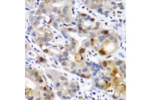 Immunohistochemistry of paraffin-embedded human gastric cancer using SUMO2 antibody (ABIN6128719, ABIN6148726, ABIN6148728 and ABIN6218594) at dilution of 1:100 (40x lens). (SUMO2 Antikörper  (AA 1-95))