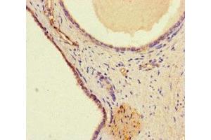 Immunohistochemistry of paraffin-embedded human prostate cancer using ABIN7175714 at dilution of 1:100