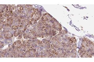 ABIN6273284 at 1/100 staining Human pancreas cancer tissue by IHC-P. (P4HA2 Antikörper  (Internal Region))