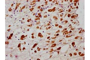 IHC image of ABIN7127713 diluted at 1:100 and staining in paraffin-embedded human melanoma cancer performed on a Leica BondTM system. (Rekombinanter MLKL Antikörper  (pSer358))