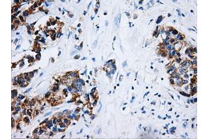 Immunohistochemical staining of paraffin-embedded Adenocarcinoma of breast tissue using anti-HSD17B10 mouse monoclonal antibody. (HSD17B10 Antikörper)