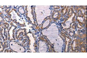 Immunohistochemistry of paraffin-embedded Human thyroid cancer using DRD1 Polyclonal Antibody at dilution of 1:50 (Dopamine Receptor d1 Antikörper)