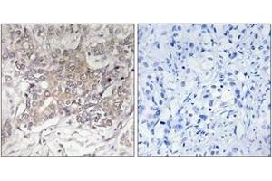 Immunohistochemistry analysis of paraffin-embedded human liver carcinoma tissue, using GCNT3 Antibody. (GCNT3 Antikörper  (AA 226-275))