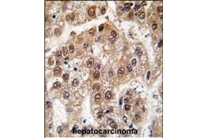 Formalin-fixed and paraffin-embedded human hepatocarcinoma tissue reacted with U2AF1 antibody (Center S70), which was peroxidase-conjugated to the secondary antibody, followed by DAB staining. (U2AF1 Antikörper  (AA 55-83))