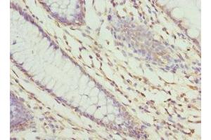 Immunohistochemistry of paraffin-embedded human colon cancer using ABIN7176235 at dilution of 1:100 (ZNF324 Antikörper  (AA 1-270))