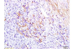 Formalin-fixed and paraffin embedded human pancreas carcinoma labeled with Anti-Glucagon Polyclonal Antibody, Unconjugated (ABIN704246) at 1:200 followed by conjugation to the secondary antibody and DAB staining (Glucagon Antikörper  (AA 53-81))
