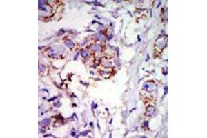 Formalin-fixed and paraffin-embedded human cancer tissue reacted with the primary antibody, which was peroxidase-conjugated to the secondary antibody, followed by DAB staining. (GRK6 Antikörper  (C-Term))