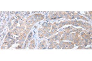 Immunohistochemistry of paraffin-embedded Human breast cancer tissue using ATG16L1 Polyclonal Antibody at dilution of 1:40(x200) (ATG16L1 Antikörper)