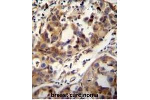 CCDC17 antibody (C-term) (ABIN654991 and ABIN2844627) immunohistochemistry analysis in formalin fixed and paraffin embedded human breast carcinoma followed by peroxidase conjugation of the secondary antibody and DAB staining. (CCDC17 Antikörper  (C-Term))