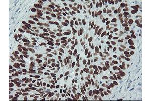 Immunohistochemical staining of paraffin-embedded Carcinoma of Human lung tissue using anti-TP53 mouse monoclonal antibody. (p53 Antikörper)