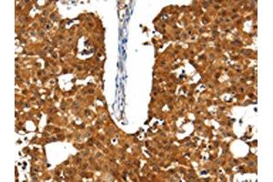 The image on the left is immunohistochemistry of paraffin-embedded Human breast cancer tissue using ABIN7192661(SSTR5 Antibody) at dilution 1/30, on the right is treated with synthetic peptide. (SSTR5 Antikörper)