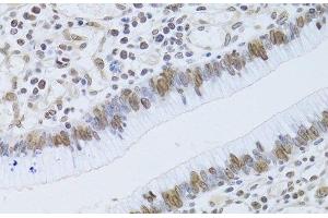 Immunohistochemistry of paraffin-embedded Human gastric cancer using LMNB2 Polyclonal Antibody at dilution of 1:100 (40x lens). (Lamin B2 Antikörper)