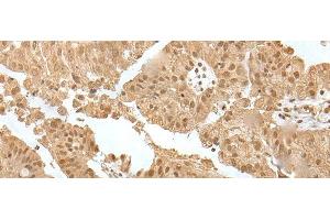 Immunohistochemistry of paraffin-embedded Human liver cancer tissue using ZNF24 Polyclonal Antibody at dilution of 1:35(x200) (ZNF24 Antikörper)