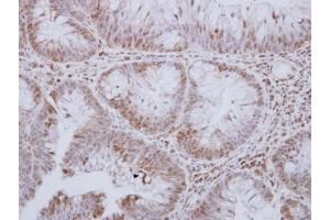 IHC-P Image STK24 antibody [N2C1], Internal detects STK24 protein at cytosol and nucleus on human breast carcinoma by immunohistochemical analysis. (STK24 Antikörper)