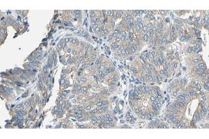 ABIN6277142 at 1/100 staining Human cervical cancer tissue by IHC-P. (CYP2E1 Antikörper  (Internal Region))