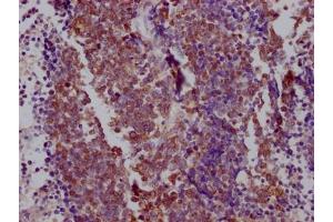 IHC image of ABIN7127859 diluted at 1:100 and staining in paraffin-embedded human lung cancer performed on a Leica BondTM system. (Rekombinanter NKX2-1 Antikörper)