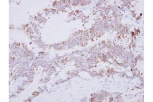 IHC-P Image Immunohistochemical analysis of paraffin-embedded human colon carcinoma, using GRAP2, antibody at 1:500 dilution. (GRAP2 Antikörper)