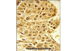 Formalin-fixed and paraffin-embedded human hepatocarcinoma reacted with E2F5 Antibody (N-term), which was peroxidase-conjugated to the secondary antibody, followed by DAB staining. (E2F5 Antikörper  (N-Term))