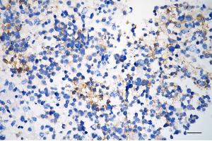 Immunohistochemistry was performed on paraffin-embedded human glioblastoma using matrix metallopeptidase 2 antibody (ABIN7799343), 1:200). (Rekombinanter MMP2 Antikörper)