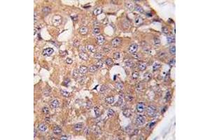 Formalin-fixed and paraffin-embedded human breast carcinoma tissue reacted with SNK Antibody (C-term ) , which was peroxidase-conjugated to the secondary antibody, followed by DAB staining. (PLK2 Antikörper  (C-Term))