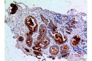 Immunohistochemistry (IHC) analysis of paraffin-embedded Human Prostatic Cancer, antibody was diluted at 1:100. (Angiopoietin 1 Antikörper  (N-Term))
