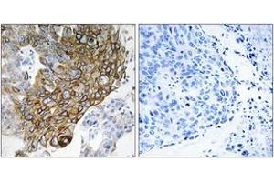 Immunohistochemistry analysis of paraffin-embedded human lung carcinoma tissue, using GJA3 Antibody.