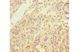 Immunohistochemistry of paraffin-embedded human pancreatic cancer using ABIN7173968 at dilution of 1:100