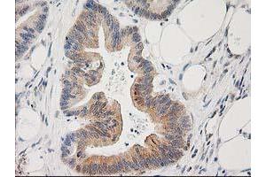 Immunohistochemical staining of paraffin-embedded Adenocarcinoma of Human colon tissue using anti-PLEKHA3 mouse monoclonal antibody. (PLEKHA3 Antikörper)