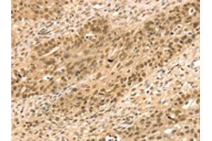 The image on the left is immunohistochemistry of paraffin-embedded Human breast cancer tissue using ABIN7131203(STAG2 Antibody) at dilution 1/35, on the right is treated with fusion protein. (STAG2 Antikörper)