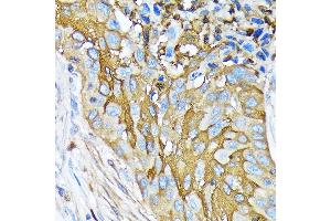 Immunohistochemistry of paraffin-embedded human lung squamous carcinoma tissue using Involucrin Rabbit mAb (ABIN6128025, ABIN6141815, ABIN6141818 and ABIN7101419) at dilution of 1:100 (40x lens). (Involucrin Antikörper)