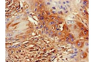 Immunohistochemistry of paraffin-embedded human cervical cancer using ABIN7164355 at dilution of 1:100 (DDX4 Antikörper  (AA 1-223))