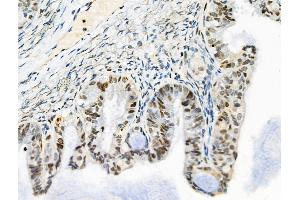ABIN6257614 and ABIN6275206 at 1/100 staining Human ovarian cancer by IHC-P.