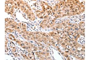 The image on the left is immunohistochemistry of paraffin-embedded Human lung cancer tissue using ABIN7129251(DPPA2 Antibody) at dilution 1/30, on the right is treated with fusion protein. (DPPA2 Antikörper)