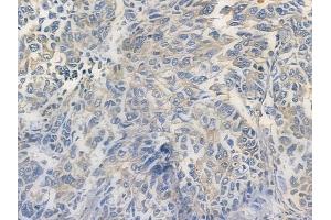 C1orf43 Antibody at 1/100 staining human lung squamous cell carcinoma by IHC-P. (C1orf43 Antikörper)