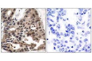 Immunohistochemical analysis of paraffin-embedded human breast carcinoma tissue using 4E-BP1 (Ab-36) antibody (E021215). (eIF4EBP1 Antikörper)