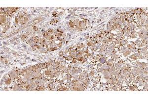 ABIN6269006 at 1/100 staining Human melanoma tissue by IHC-P. (Metabotropic Glutamate Receptor 6 Antikörper  (C-Term))