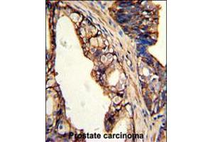 Formalin-fixed and paraffin-embedded human prostate carcinoma with TGM4 Antibody , which was peroxidase-conjugated to the secondary antibody, followed by DAB staining. (TGM4 Antikörper  (AA 135-164))