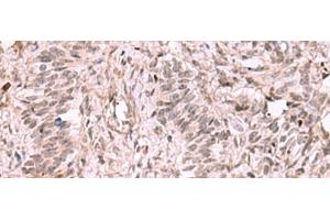 Immunohistochemistry of paraffin-embedded Human ovarian cancer tissue using KDM7A Polyclonal Antibody at dilution of 1:35(x200) (JHDM1D Antikörper)