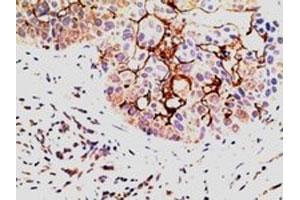 EPS8 polyclonal antibody (Cat # PAB6473, 5 ug/mL) staining of paraffin embedded human breast Carcinoma. (EPS8 Antikörper)