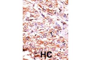 Formalin-fixed and paraffin-embedded human cancer tissue reacted with the primary antibody, which was peroxidase-conjugated to the secondary antibody, followed by AEC staining. (GUCY1A2 Antikörper  (N-Term))