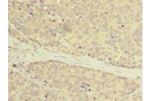 Immunohistochemistry of paraffin-embedded human gastric cancer using ABIN7175069 at dilution of 1: 100 (C2orf27A Antikörper  (AA 3-174))