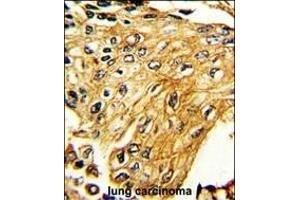 Formalin-fixed and paraffin-embedded human lung carcinoma reacted with IFNGR2 Antibody (C-term), which was peroxidase-conjugated to the secondary antibody, followed by DAB staining. (IFNGR2 Antikörper  (C-Term))