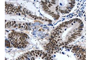The image on the left is immunohistochemistry of paraffin-embedded Human colon cancer tissue using ABIN7191321(LRP5 Antibody) at dilution 1/55, on the right is treated with synthetic peptide. (LRP5 Antikörper)