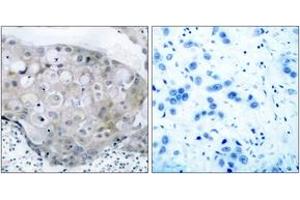 Immunohistochemistry analysis of paraffin-embedded human breast carcinoma, using VEGFR2 (Phospho-Tyr951) Antibody. (VEGFR2/CD309 Antikörper  (pTyr951))