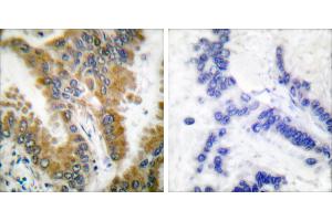 Peptide - +Immunohistochemical analysis of paraffin-embedded human lung carcinoma tissue, using CrkL (Ab-207) antibody (#B0067). (CrkL Antikörper  (Tyr207))