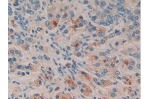 IHC-P analysis of Human Prostate cancer Tissue, with DAB staining. (SGK2 Antikörper  (AA 40-311))